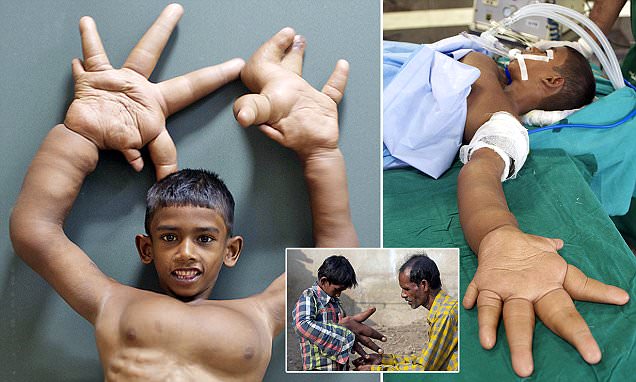 *** EXCLUSIVE *** COIMBATORE, INDIA - NOVEMBER: Kaleem takes a playful pose whilst being examined at Ganga Hospital in Coimbatore, where doctors will attempt to scale back the size of his hands and improve his standard of living. , in November 2014, India. 8 year old Mohammad Kaleem was born with a rare medical condition called macrodactyly, or local gigantism, which has made his hands grow to huge proportions. In his remote Indian village, he is described as a devil child and is the victim of bullies ñ even excluded from attending school. Media reports about the boyís extraordinary condition attract the attention of the medical staff at a Coimbatore hospital, who offer to operate on Kaleem in an attempt to improve his functionality, mobility and overall standard of life. Barcroft Productions follow these surgeries, Kaleemís progress and his eventual return to the village and everyday life. PHOTOGRAPH BY Channel 5 / Barcroft Productions UK Office, London. T +44 845 370 2233 W www.barcroftmedia.com USA Office, New York City. T +1 212 796 2458 W www.barcroftusa.com Indian Office, Delhi. T +91 11 4053 2429 W www.barcroftindia.com