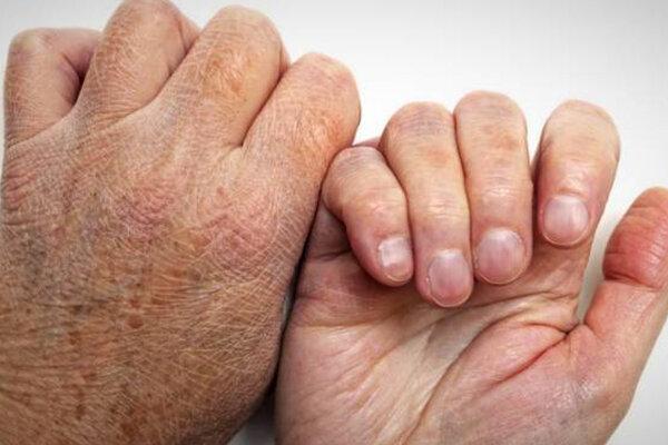 وزارت بهداشت: شیوع جذام در کشور کذب است/ کمتر از ۱۰ مورد ابتلا در سال