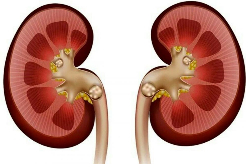 علائم، درمان و باورهای غلط درباره سنگ کلیه